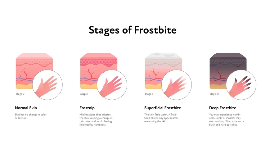 Stages of Frostbite graphic